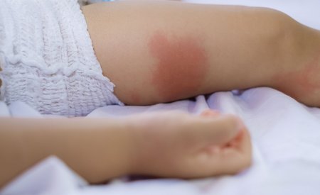 Baby - Atopic Skin Baby - Atopic Skin