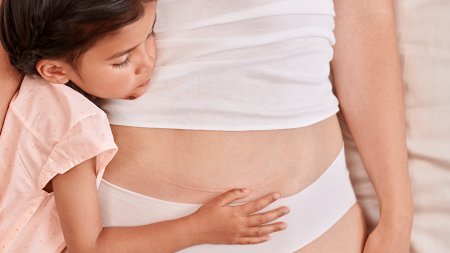 A woman and a child with various scars that can be treated with Cicabio Crème+