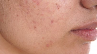 Bioderma - Acne Oily Skin