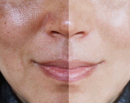 bioderma-your-skin_pigmentbio_c-concentrate_before-after