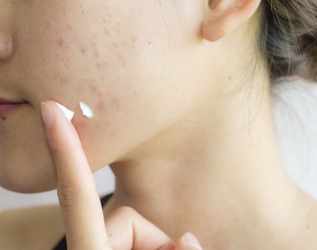cream for treating acne