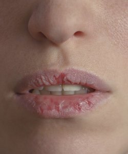 Your Skin - Woman - Dry Lips